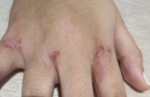 dermatitis atopica en manos tratada con bioterapia