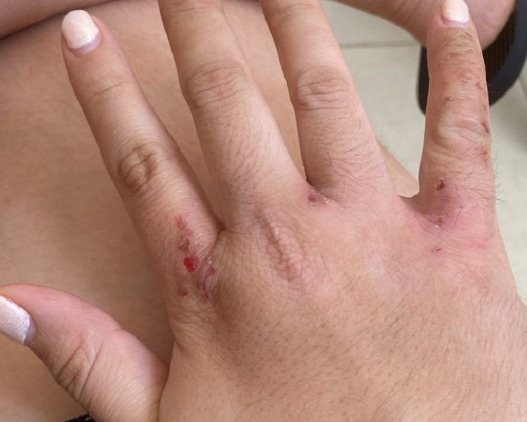 dermatitis atopica en manos tratada con bioterapia