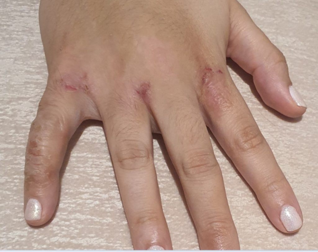 dermatitis atopica en manos tratada con bioterapia