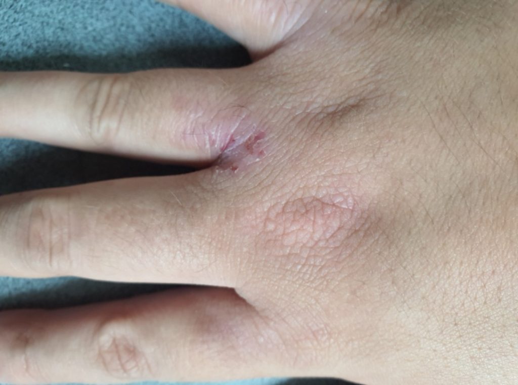 dermatitis atopica en manos tratada con bioterapia