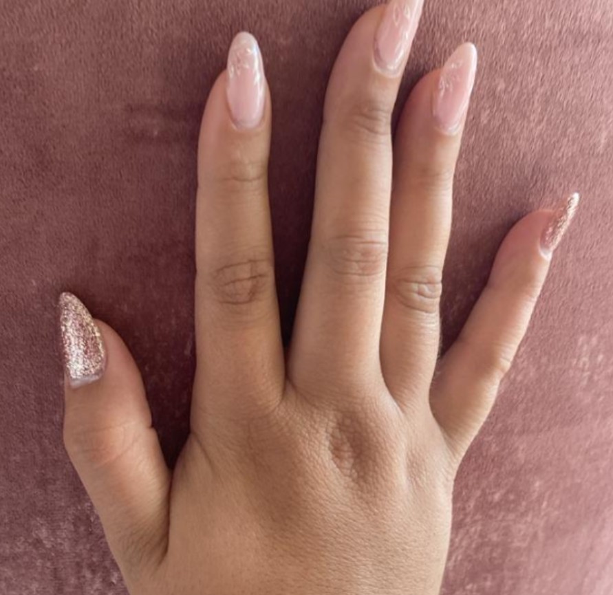 dermatitis atopica en manos tratada con bioterapia